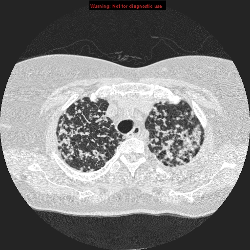 File:Bronchoalveolar carcinoma (Radiopaedia 13224-13233 B 2).jpg