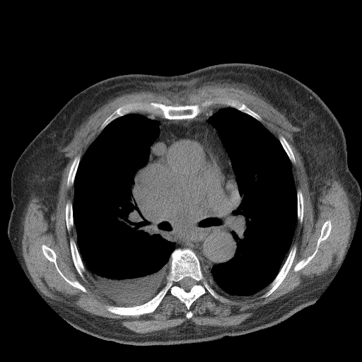 Bronchogenic carcinoma with metastatic lymphadenopathy (Radiopaedia 37671-39569 Axial non-contrast 25).jpg