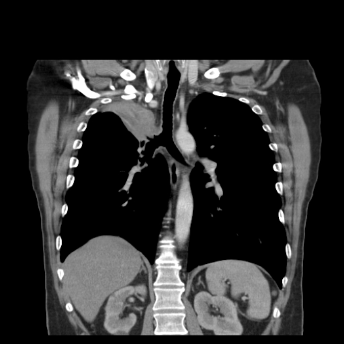 Bronchogenic carcinoma with upper lobe collapse (Radiopaedia 29297-29726 D 35).jpg