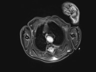 File:Bronchogenic cyst (Radiopaedia 27207-27380 Axial STIR 11).jpg