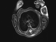 File:Bronchogenic cyst (Radiopaedia 27207-27380 Axial STIR 8).jpg