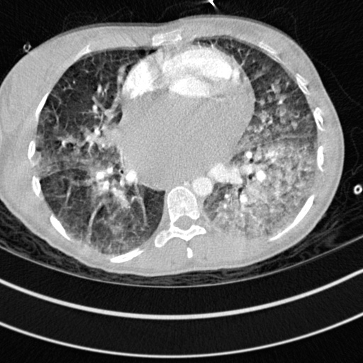 Bronchogenic cyst (Radiopaedia 77801-90071 Axial lung window 47).jpg