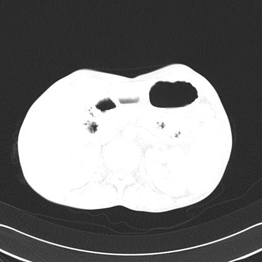 Bronchopleural fistula secondary to tuberculosis (Radiopaedia 20415-20322 Axial lung window 67).jpg