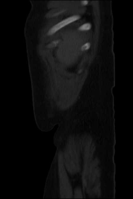Brown tumors compressing the spinal cord (Radiopaedia 68442-77988 H 53).jpg