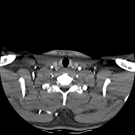 Buccal fat pad arteriovenous malformation (Radiopaedia 70936-81144 D 70).jpg