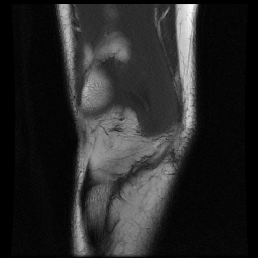 File:Bucket handle meniscus tear (Radiopaedia 56916-63751 Coronal T1 5).jpg