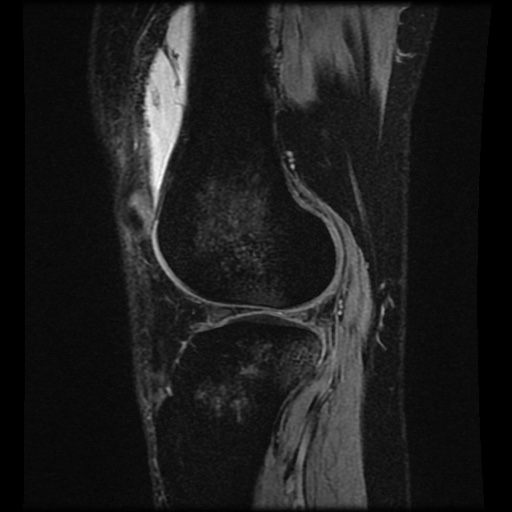 Bucket handle meniscus tear (Radiopaedia 56916-63751 H 22).jpg