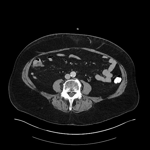 Buried bumper syndrome - gastrostomy tube (Radiopaedia 63843-72575 A 57).jpg