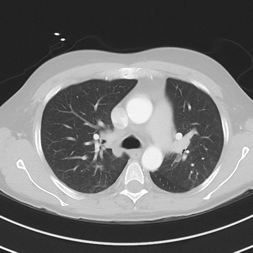 Burkitt lymphoma (Radiopaedia 34686-36121 Axial lung window 19).png