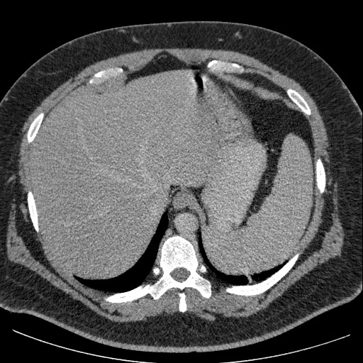 Burned-out testicular seminoma - retroperitoneal nodal metastases (Radiopaedia 62872-71245 A 12).jpg