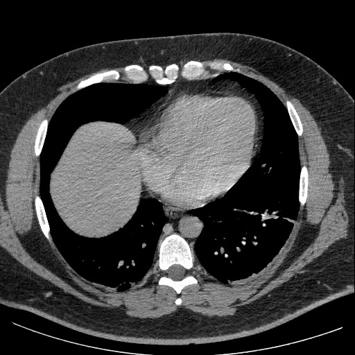 File:Burned-out testicular seminoma - retroperitoneal nodal metastases (Radiopaedia 62872-71245 A 5).jpg