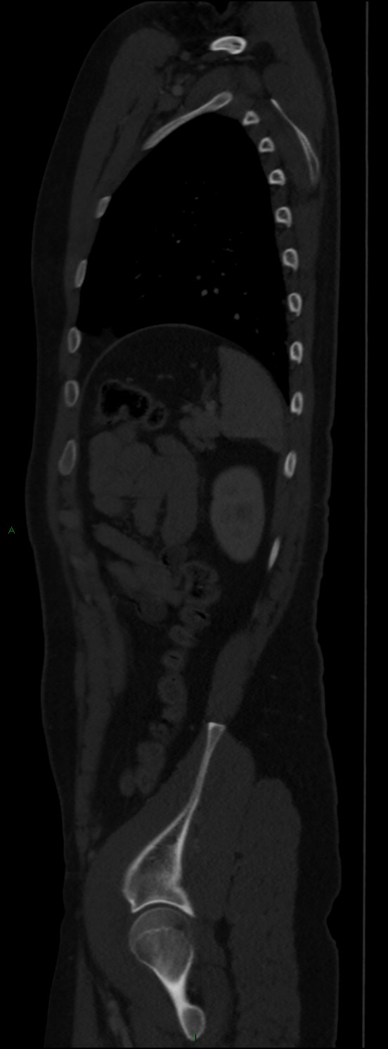 Burst fracture (Radiopaedia 83168-97542 Sagittal bone window 97).jpg