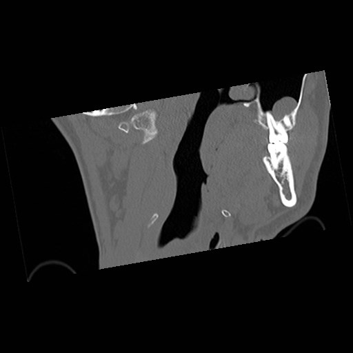 File:C1-C2 "subluxation" - normal cervical anatomy at maximum head rotation (Radiopaedia 42483-45607 Coronal non-contrast 3).jpg
