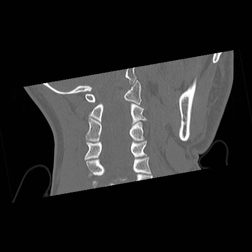 C1-C2 "subluxation" - normal cervical anatomy at maximum head rotation (Radiopaedia 42483-45607 Coronal non-contrast 30).jpg