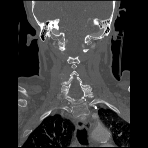 C1 anterior arch (plough) fracture - type 1 (Radiopaedia 76181-87720 Coronal bone window 41).jpg