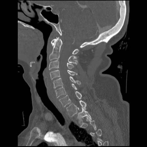 File:C1 anterior arch (plough) fracture - type 1 (Radiopaedia 76181-87720 Sagittal bone window 60).jpg
