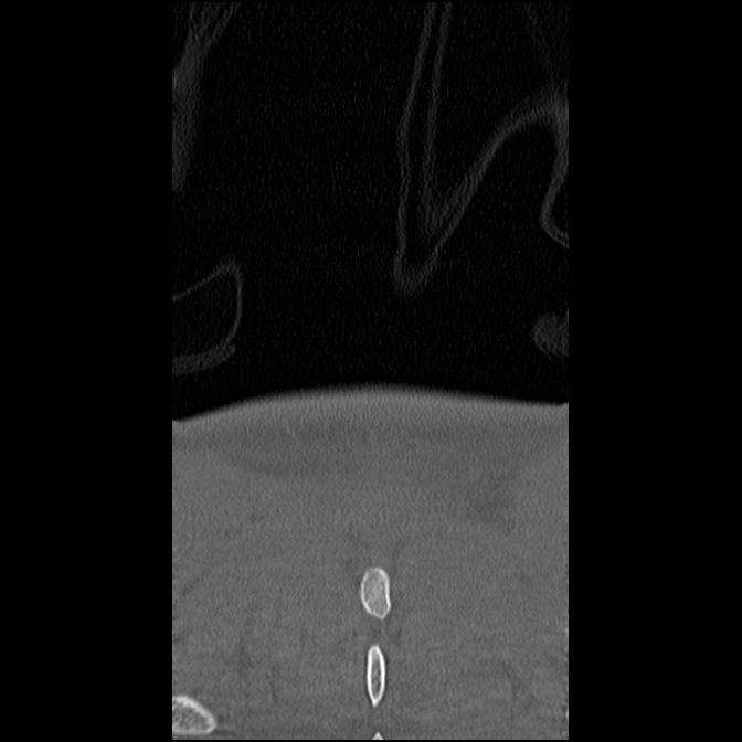 C5 facet fracture (Radiopaedia 58374-65499 Coronal bone window 64).jpg