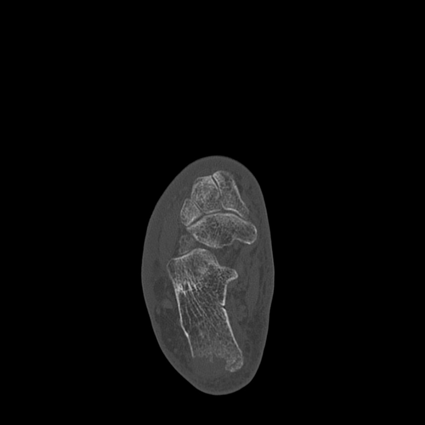 Calcaneal tuberosity avulsion fracture (Radiopaedia 22649-22668 Axial bone window 26).jpg