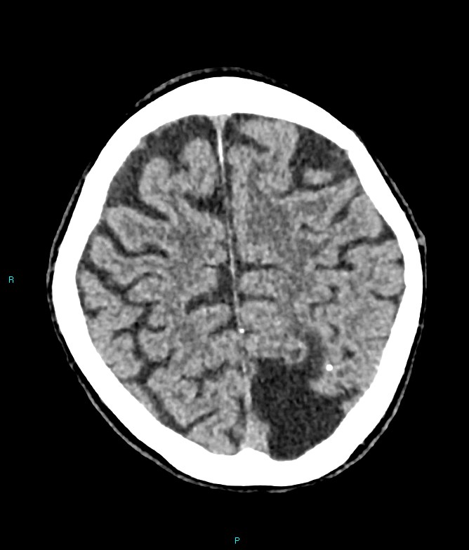 Calcified cerebral emboli from left ventricular thrombus (Radiopaedia 84420-99758 Axial non-contrast 25).jpg