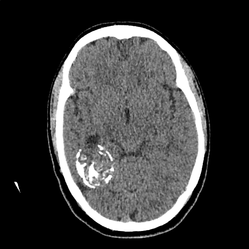 Calcified cerebral hydatid cyst (Radiopaedia 65603-74717 Axial non-contrast 29).jpg
