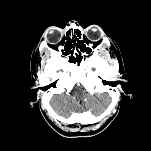 Calcified cerebral hydatid cyst (Radiopaedia 65603-74717 Axial with contrast 7).jpg