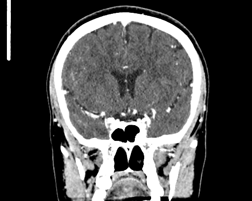 Calcified cerebral hydatid cyst (Radiopaedia 65603-74717 C 27).jpg
