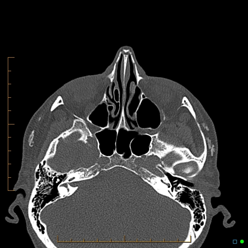 Calcified facial augmentation fillers (Radiopaedia 79514-92679 Axial bone window 1).jpg