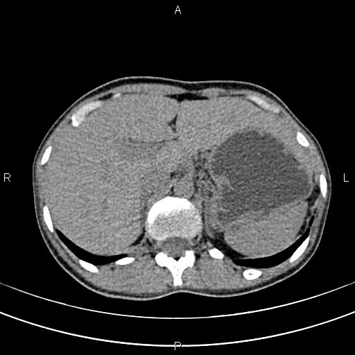 File:Calcified hepatic hydatid cyst (Radiopaedia 83870-99072 Axial non-contrast 42).jpg