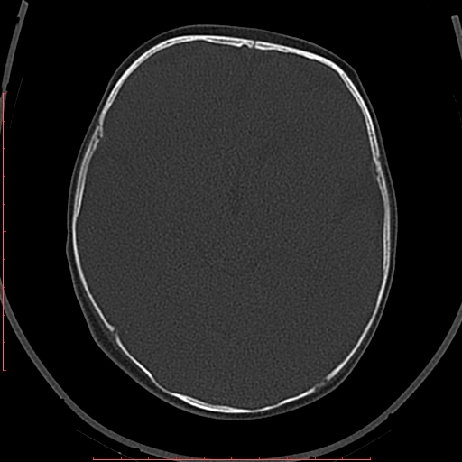 Calcified middle cerebral artery embolism (Radiopaedia 78949-91860 Axial bone window 25).jpg