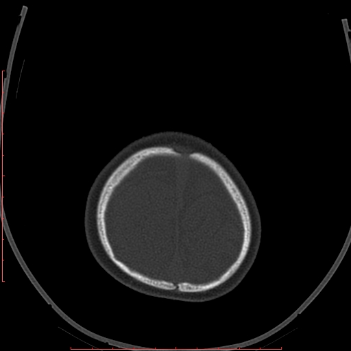 File:Calcified middle cerebral artery embolism (Radiopaedia 78949-91860 Axial bone window 66).jpg