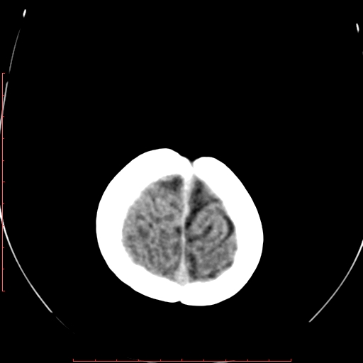 File:Calcified middle cerebral artery embolism (Radiopaedia 78949-91860 Axial non-contrast 24).jpg