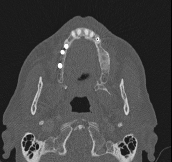 Caldwell-Luc operation (Radiopaedia 52329-58225 Axial bone window 45).jpg