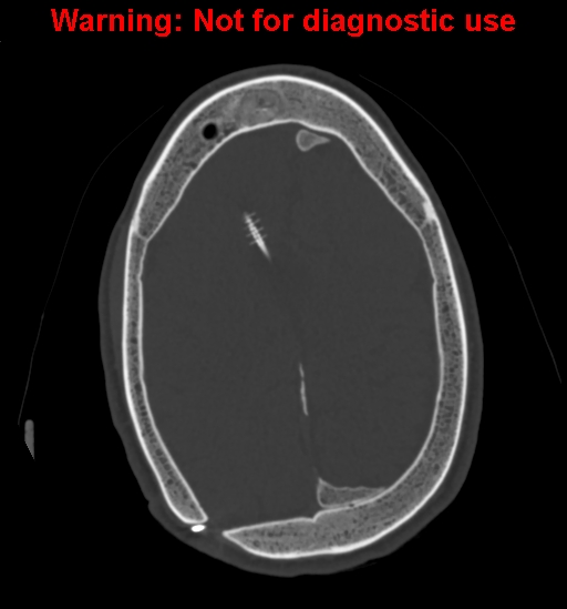 File:Calvarial thickening from chronic shunting (Radiopaedia 60079-67637 Axial bone window 129).jpg