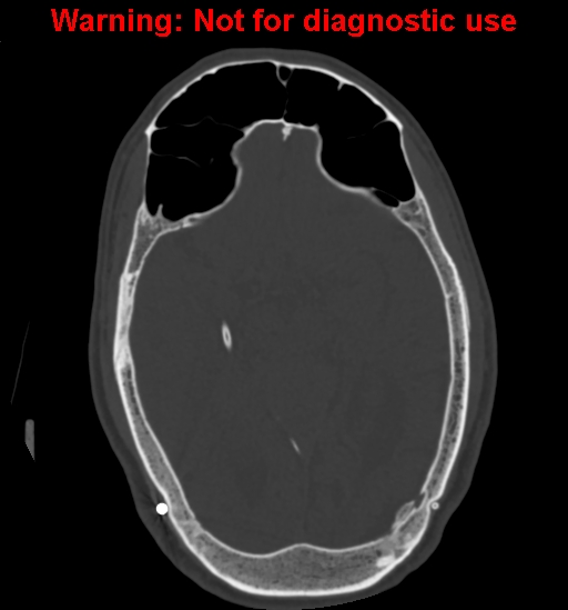 Calvarial thickening from chronic shunting (Radiopaedia 60079-67637 Axial bone window 83).jpg