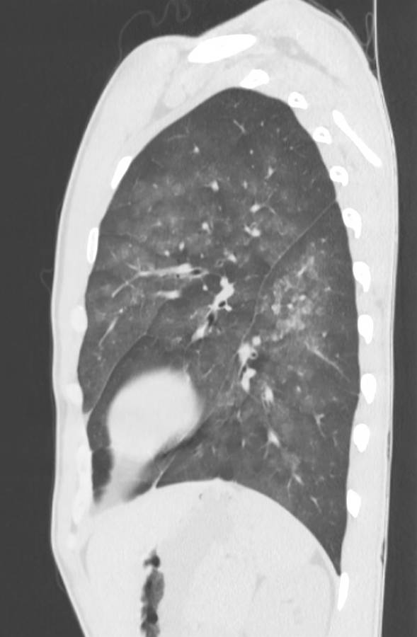 Cannabis-induced diffuse alveolar hemorrhage (Radiopaedia 89834-106946 Sagittal lung window 105).jpg