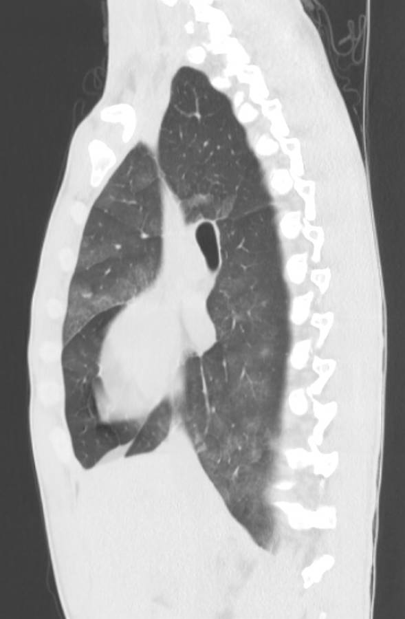 Cannabis-induced diffuse alveolar hemorrhage (Radiopaedia 89834-106946 Sagittal lung window 58).jpg