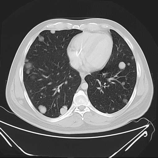 File:Cannonball pulmonary metastases (Radiopaedia 67684-77101 Axial lung window 17).jpg