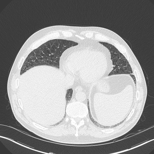 Caplan syndrome (Radiopaedia 56667-63530 Axial lung window 152).jpg