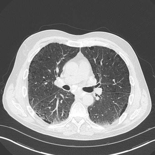 Caplan syndrome (Radiopaedia 56667-63530 Axial lung window 97).jpg