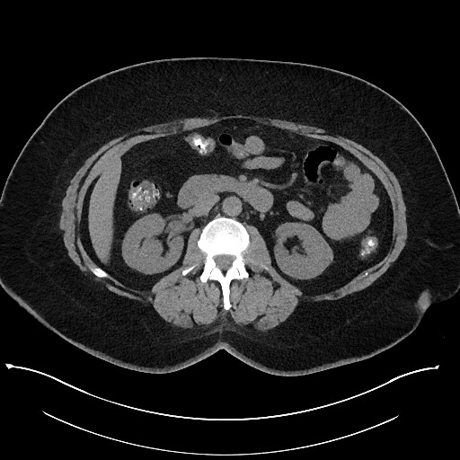 Carcinoid tumor - terminal ileum (Radiopaedia 60931-68740 Axial non-contrast 47).jpg