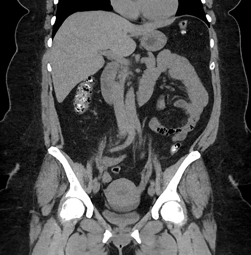 Carcinoid tumor - terminal ileum (Radiopaedia 60931-68740 Coronal non-contrast 48).jpg