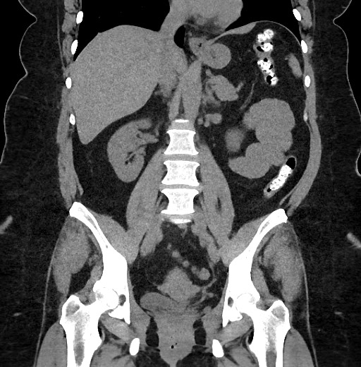 Carcinoid tumor - terminal ileum (Radiopaedia 60931-68740 Coronal non-contrast 60).jpg
