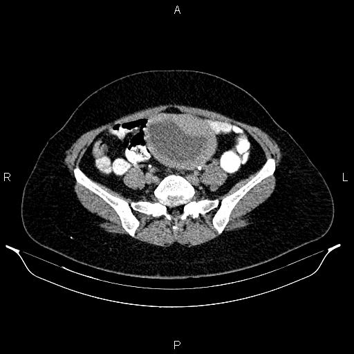 File:Carcinoma of uterine cervix (Radiopaedia 85861-101700 Axial C+ delayed 60).jpg