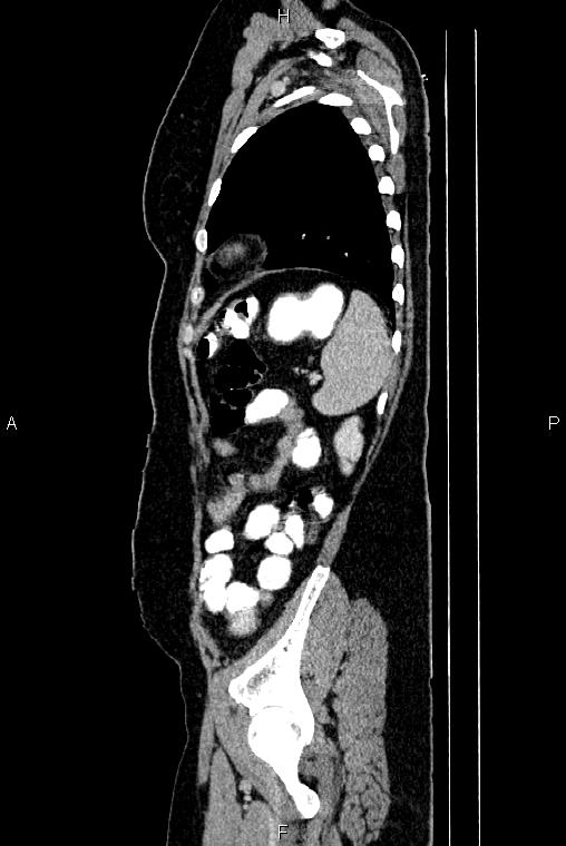 Carcinoma of uterine cervix (Radiopaedia 85861-101700 D 71).jpg