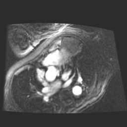 File:Cardiac fibroma (Radiopaedia 38974-41150 4 chamber FGRET 8).jpg