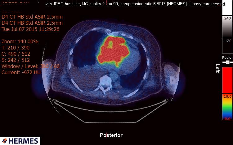 File:Cardiac lymphoma (Radiopaedia 38690-40871 Integrated PET-CT 16).jpg
