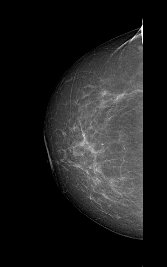 File:Cardiac pacemaker (mammography) (Radiopaedia 72298-82831 R CC 1).PNG