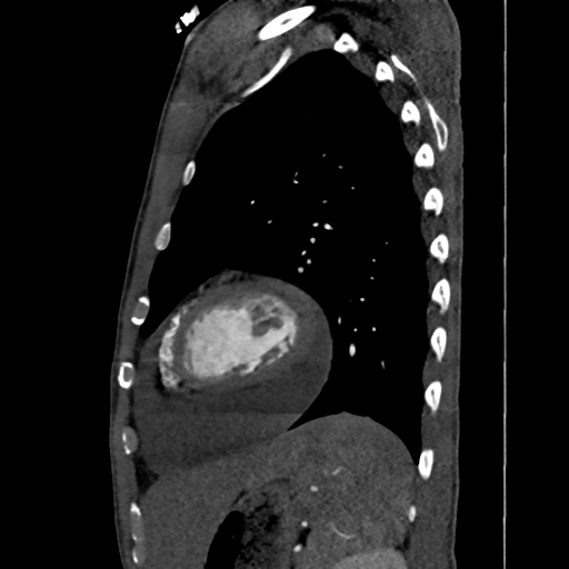 Cardiac tumor - undifferentiated pleomorphic sarcoma (Radiopaedia 45844-50134 B 15).png