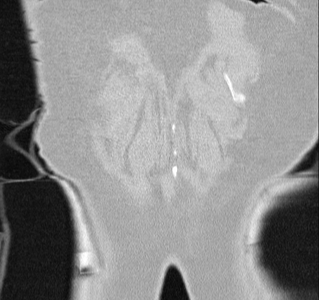Cardiogenic pulmonary edema (Radiopaedia 29213-29609 Coronal lung window 66).jpg