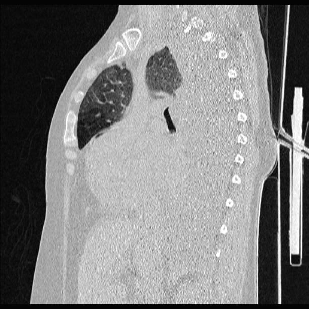 Cardiogenic pulmonary edema (Radiopaedia 29213-29609 Sagittal lung window 41).jpg